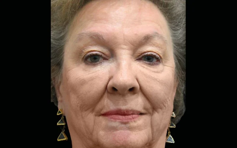 EMFACE + EXILIS kombinált arckezelés előtte
