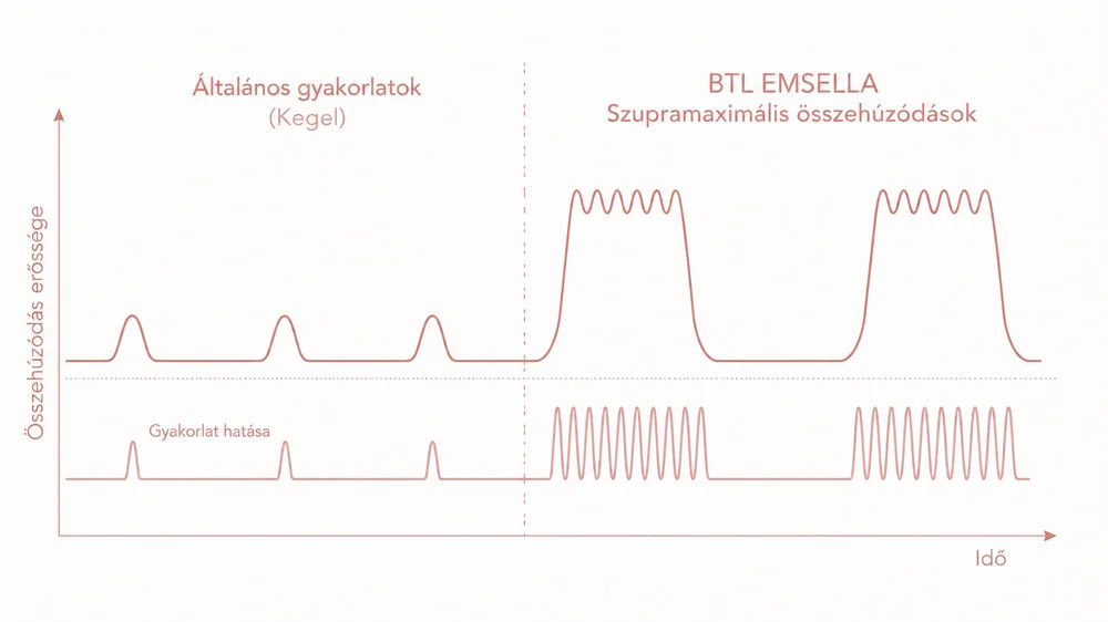 EMSELLA® szupramaximális izomösszehúzódás – HIFEM® technológia