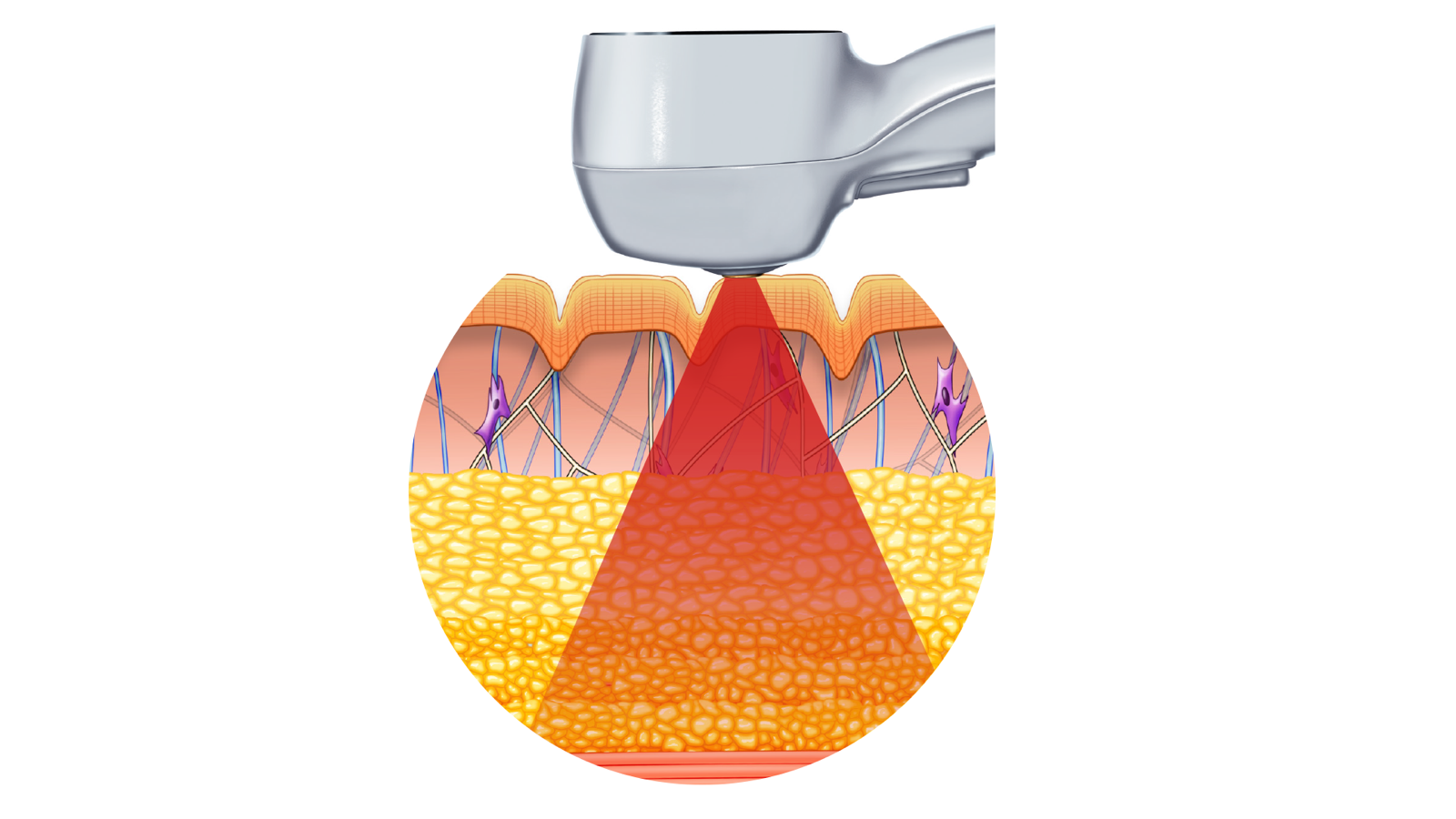 Exilis Ultra 360 – 360°-os volumetrikus melegítés